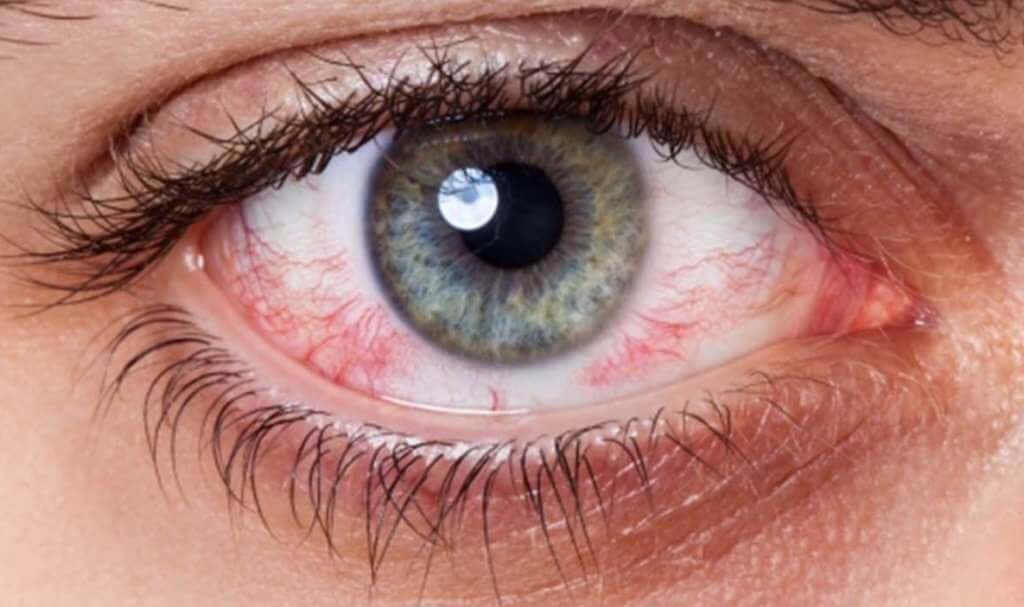 Лікування синдрому сухого ока